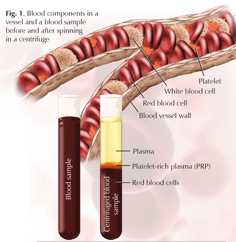 PlateletRich Plasma Therapy Wellness at Hughston Clinic Tennessee