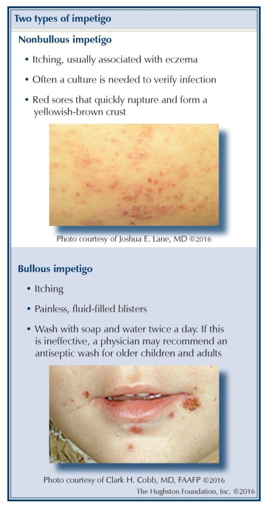 bullous impetigo in children