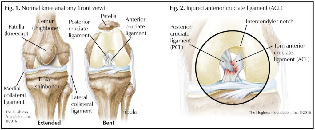 Anterior Cruciate Ligament Tear (ACL Tear) - The Institute for Athletic  Medicine