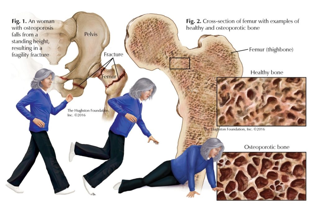 Pelvic Fractures - Hughston Clinic