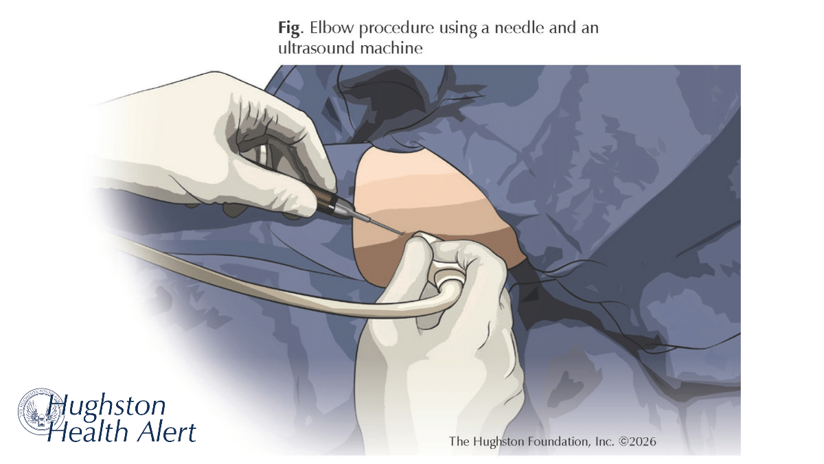 Ultrasound Guidance for Musculoskeletal Injections